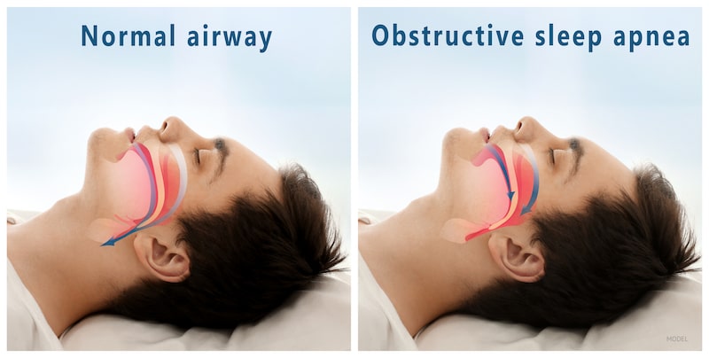 Is Sleep Apnea Dangerous How Can This Affect Your Health And Well Being La Jolla Cosmetic