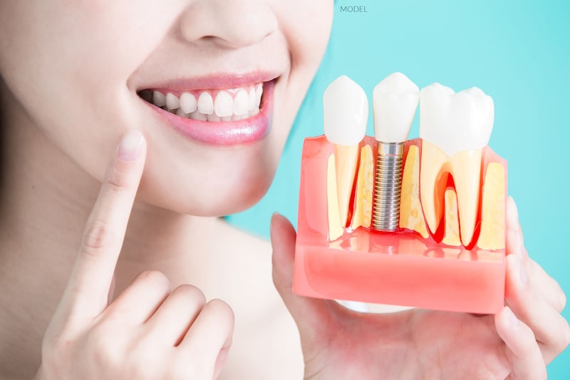  Women smiling and holding a model of a dental implant.